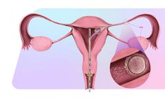 FemaSeed - Localized Directional Insemination Device