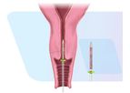 FemCerv - Cleared Endocervical Sampler