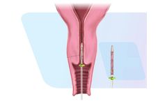 FemCerv - Cleared Endocervical Sampler