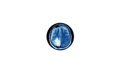 Glioblastoma Multiforme (GBM)