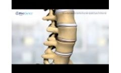 DiscGenics` IDCT Cell Therapy for DDD - Video