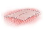 Biodesign - 1-Layer Tissue Graft