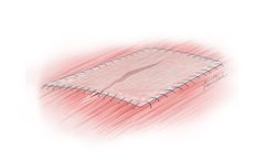 Biodesign - 1-Layer Tissue Graft