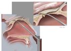 Biodesign - Duraplasty Graft