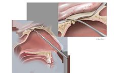 Biodesign - Duraplasty Graft