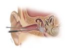 Biodesign - Otologic Repair Graft