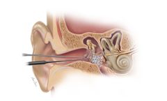 Biodesign - Otologic Repair Graft