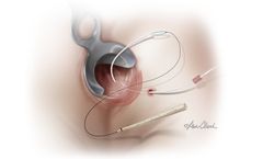 Biodesign - Anal Fistula Plug Set