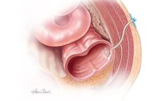 Biodesign - Enterocutaneous Fistula Plug