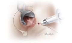 Biodesign - Fistula Plug Set