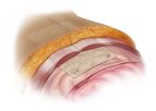 Biodesign - Hernia Graft
