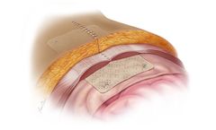 Biodesign - Hernia Graft