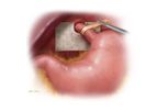 Biodesign - Hiatal Hernia Graft
