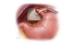 Biodesign - Hiatal Hernia Graft