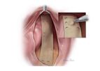 Biodesign - Rectopexy Graft