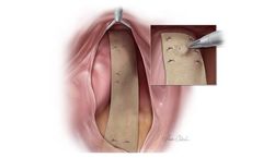 Biodesign - Rectopexy Graft
