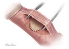 Biodesign - Peyronie’s Repair Graft
