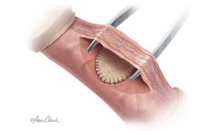 Biodesign - Peyronie’s Repair Graft