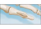 i2b AlloAid - Model DIP - Engineered Sterile Allograft for Arthrodesis