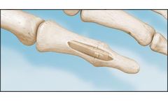 i2b AlloAid - Model DIP - Engineered Sterile Allograft for Arthrodesis