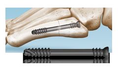 i2b 5MS - Jones Fracture Screws
