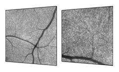 SPECTRALIS - High Magnification Module