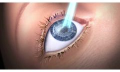 Features of SCHWIND AMARIS Excimer Laser for refractive surgery laser treatments - Video