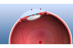 SCHWIND Amaris 500E with 5D Eyetracking - Audio Version - Video