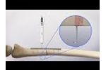 Electronic Depth Gauge (EDG) - for Orthopedic Surgical Fracture Repair - Video