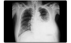 Lung Therapeutics - Model LTI-01 - First-in-Class Treatment for Loculated Pleural Effusion (LPE)