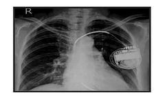 Medicomp TelePatch - Stress-Free Implantable Device Monitoring