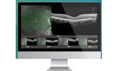 Notal - Model OCT - Computational Image Analyzer