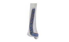 Tibia XLOC - Distal Anterolateral Plate