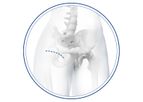 Medacta - Model BIKINI - Anterior Minimally Invasive Surgical Hip Replacement Joint (AMIS)