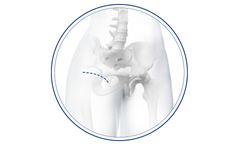 Medacta - Model BIKINI - Anterior Minimally Invasive Surgical Hip Replacement Joint (AMIS)