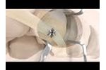Coronet Soft Tissue Fixation System Kidner Animation from CoNextions Medical - Video