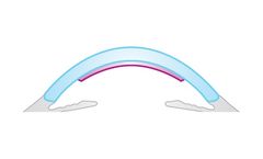 Nano-Thin - Model DSAEK - Descemet’s Stripping Automated Endothelial Keratoplasty