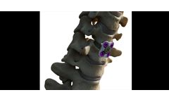 SETx - Cervical Plate System