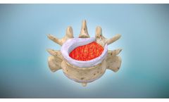 Fibrin-PTH (KUR-113) from Kuros Biosciences - Video