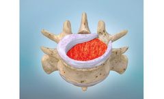 Model KUR-113 - Drug-Biologic Combination for Spinal Fusion
