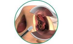 VivAer - Nasal Airway Obstruction Solution