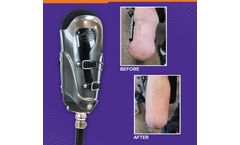 The iFIT device gently and comfortably reshapes the residual limb.