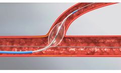 Glider - Model PTCA - Balloon Catheter