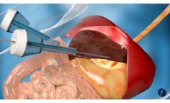 FreeHold Surgical: FreeHold Trio and FreeHold Duo Hands-Free Intracorporeal Retractors Animation - Video