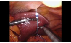 FreeHold Surgical: FreeHold Trio Retractor liver retraction during robotic sleeve gastrectomy - Video