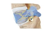 Intracept - Procedure