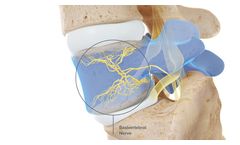 Intracept - Procedure