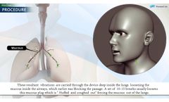 PneumoCare`s MuClear Procedure - Video