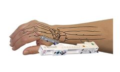 Agee WristJack - Incremental, Multiplanar Reduction for Distal Radius Fractures