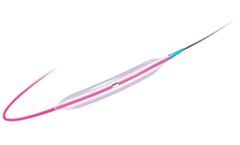 Sapphire - Model II PRO 1.0 mm - Coronary Dilatation Catheter